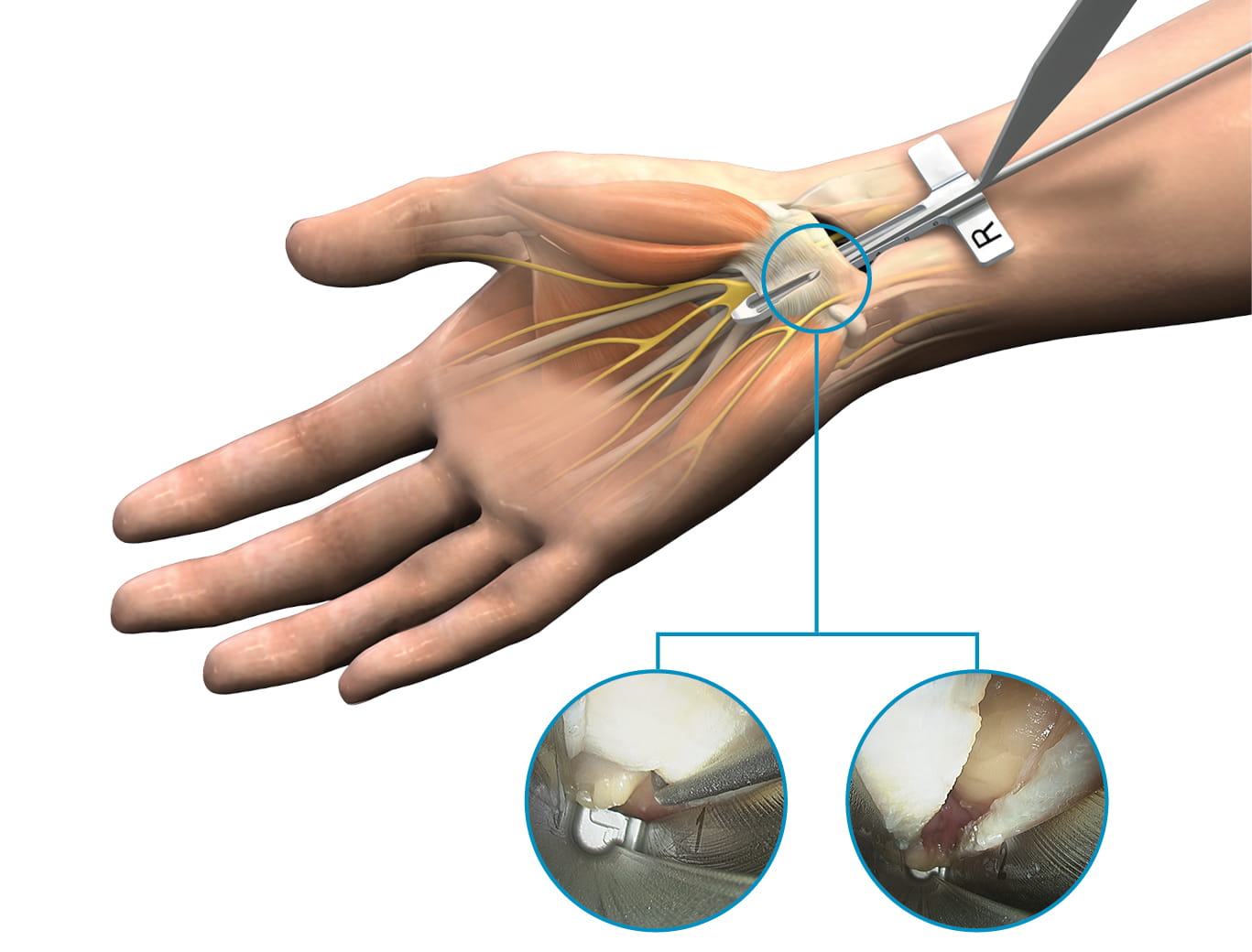 Hand Surgery