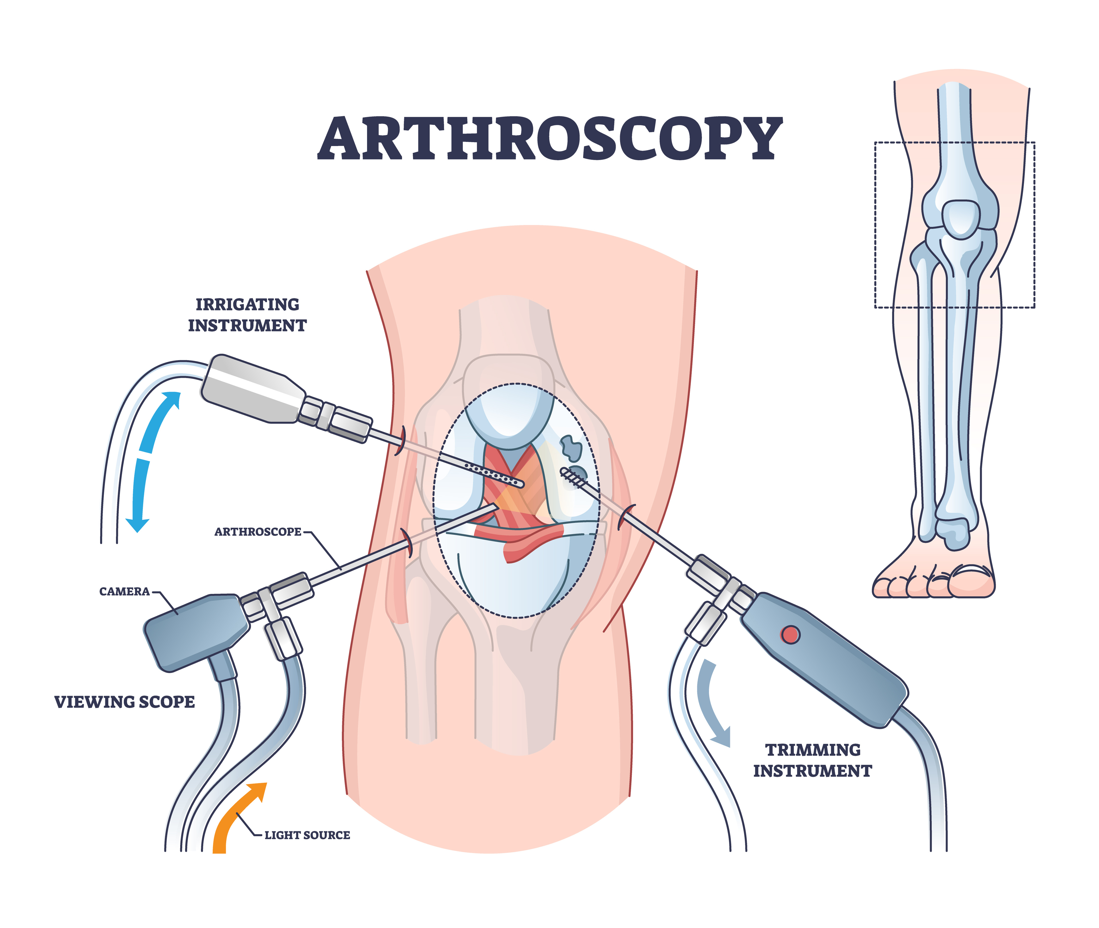 Knee Surgery