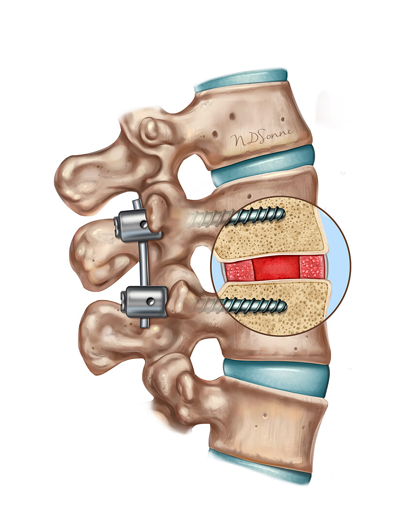 Spine Surgery